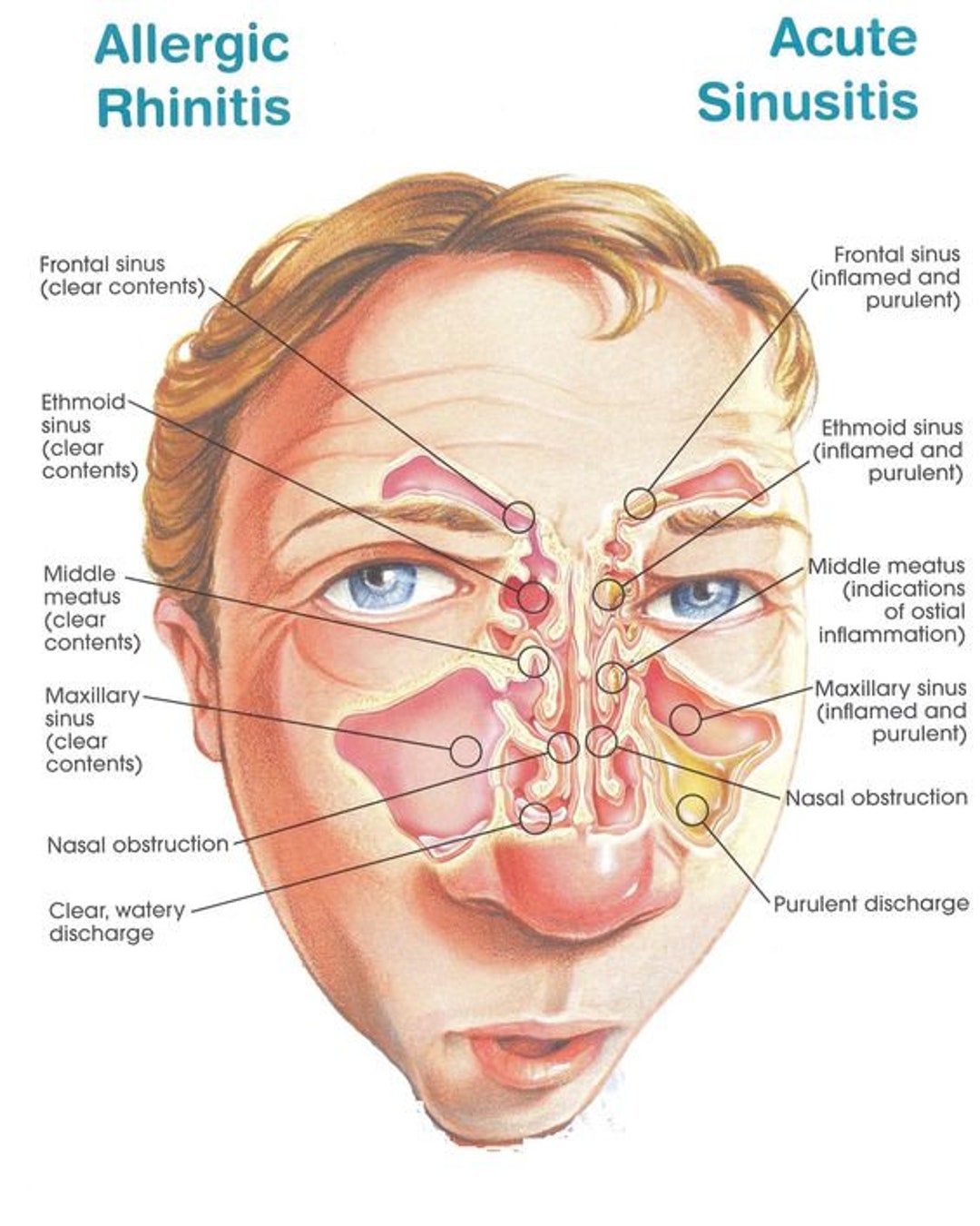 Allergic Rhinitis and Acute Sinusitis Poster, Human Anatomical Poster
