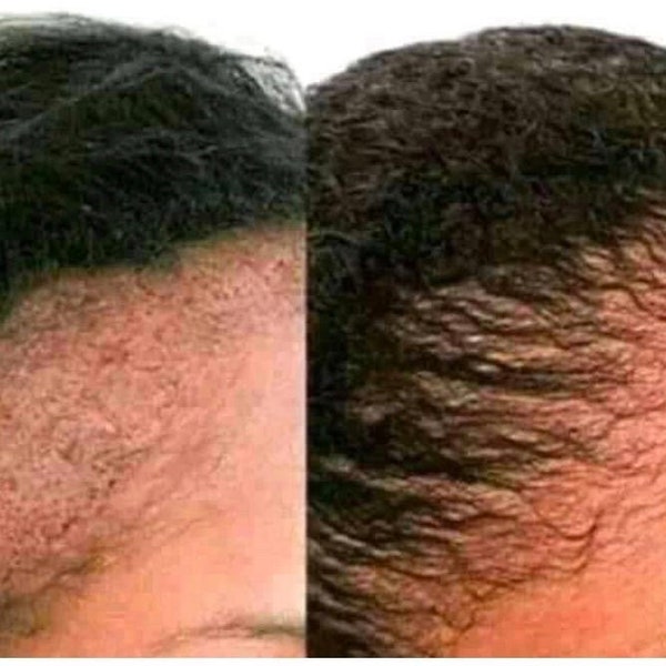 Schnelles HaarWachstum Set, Kantenbehandlungsset / Chebe Haarwuchsfett / Ayurvedisches Haarwuchsöl, Verhindert vorzeitiges Ergrauen, Schuppen Frizziness