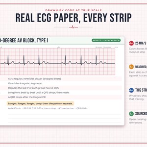 May include: A white educational card titled Real ECG Paper, Every Strip featuring a Second-Degree AV Block, Type I tracing on a red grid. It includes technical data, rhythm analysis, and notes on a 25 mm/s and 10 mm/mV scale for medical reference.