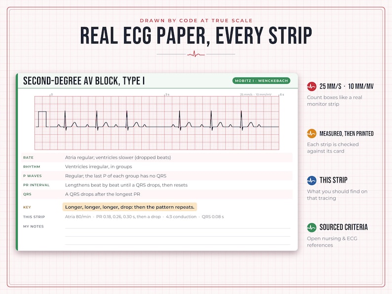 May include: A white educational card titled Real ECG Paper, Every Strip featuring a Second-Degree AV Block, Type I tracing on a red grid. It includes technical data, rhythm analysis, and notes on a 25 mm/s and 10 mm/mV scale for medical reference.