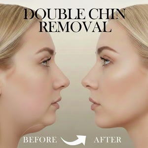 May include: A before-and-after comparison of a woman's profile, illustrating double chin removal. The image shows the face from the side, with the text "DOUBLE CHIN REMOVAL" at the top. The word "BEFORE" is on the left, and "AFTER" on the right.