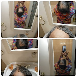 4 oz. Alopecia and Balding Follicle Stimulator. (Visit our at www.theglorygrowthcollection.com)