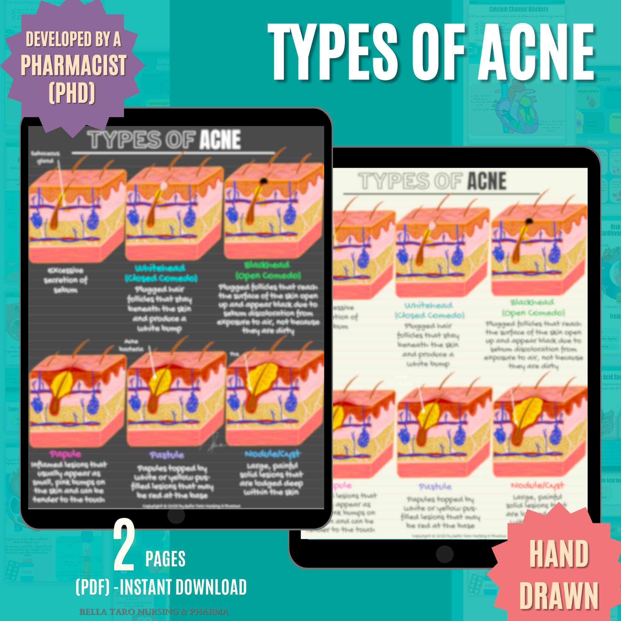 Hand-drawn Acne Types Diagram: Esthetician Skin Anatomy | Skin Anatomy ...