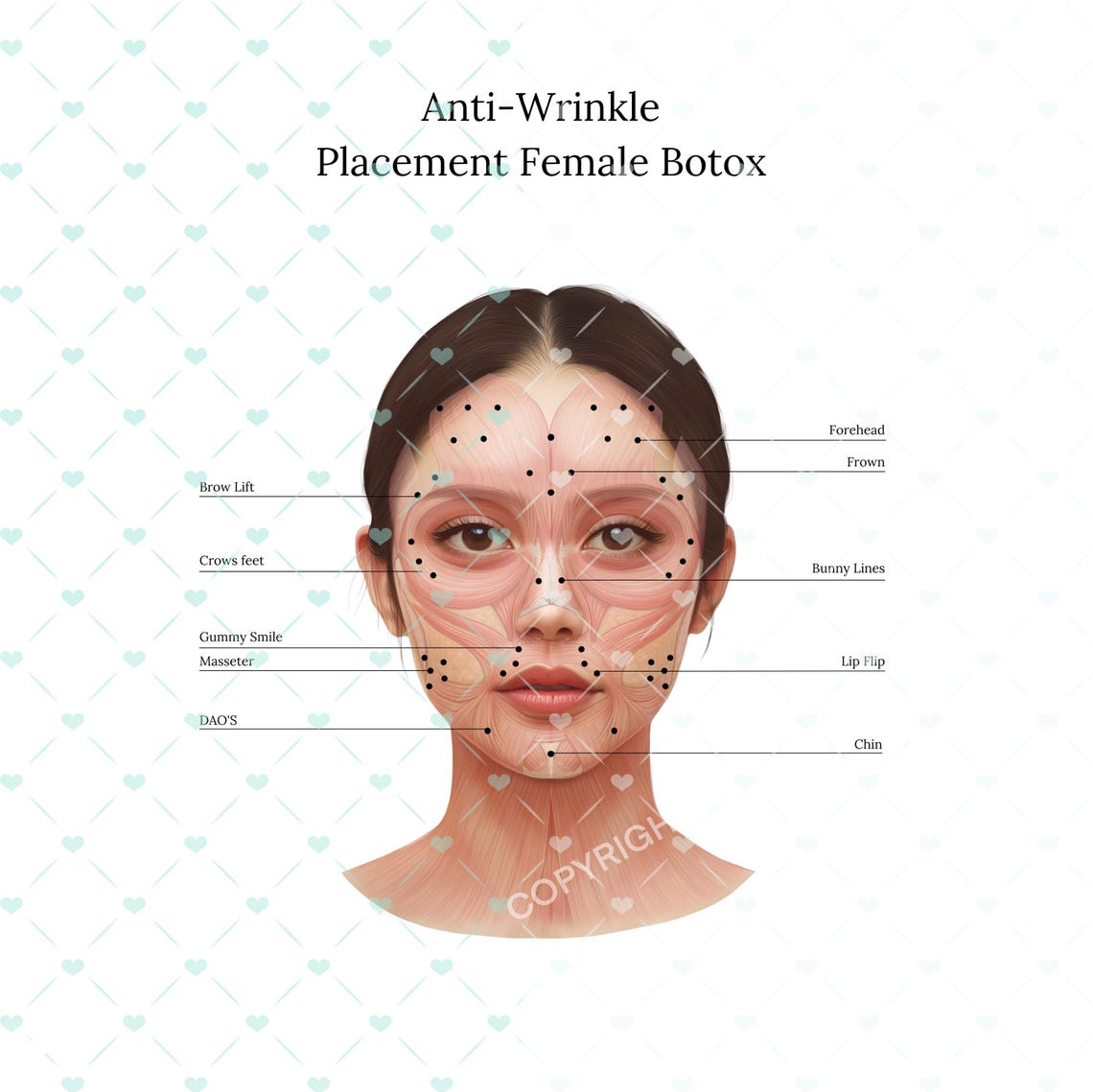 Botox Injection Points on Muscle Anatomy PNG| Botox & Filler Injector ...