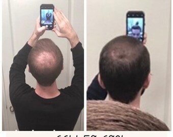 Best Product for Hair Loss and Hair Growth for Men and Women! Better than a Hair Transplant! (3 Month Kit)