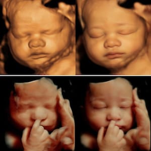 3D, 4D, 5D and HD Ultrasound. Turn your ultrasound into a REALISTIC ultrasound with your baby's face, HD ultrasound gift Ultrasound image 3