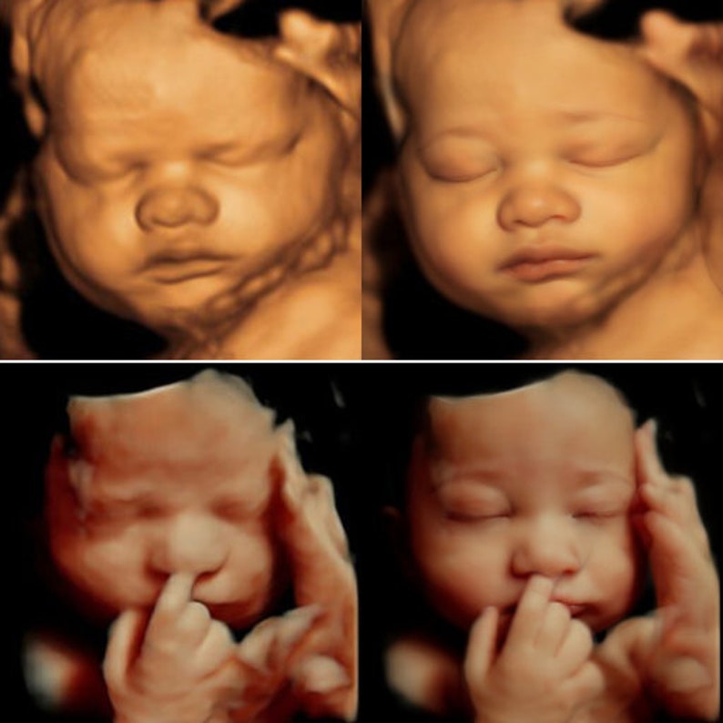 3D, 4D, 5D and HD Ultrasound. Turn your ultrasound into a REALISTIC ultrasound with your baby's face, HD ultrasound gift Ultrasound image 3