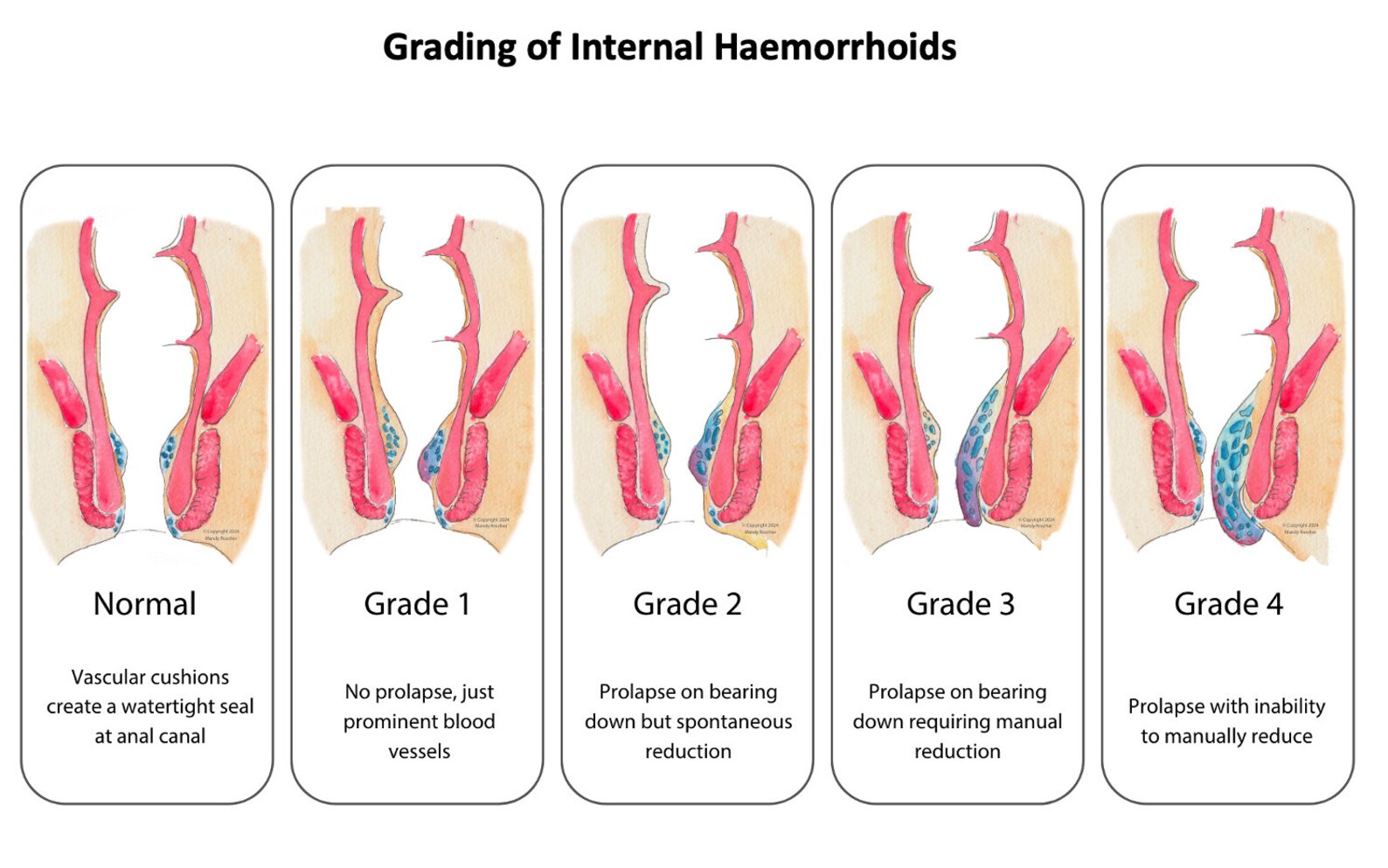 Grading Of Internal Haemorrhoids Digital Download Etsy