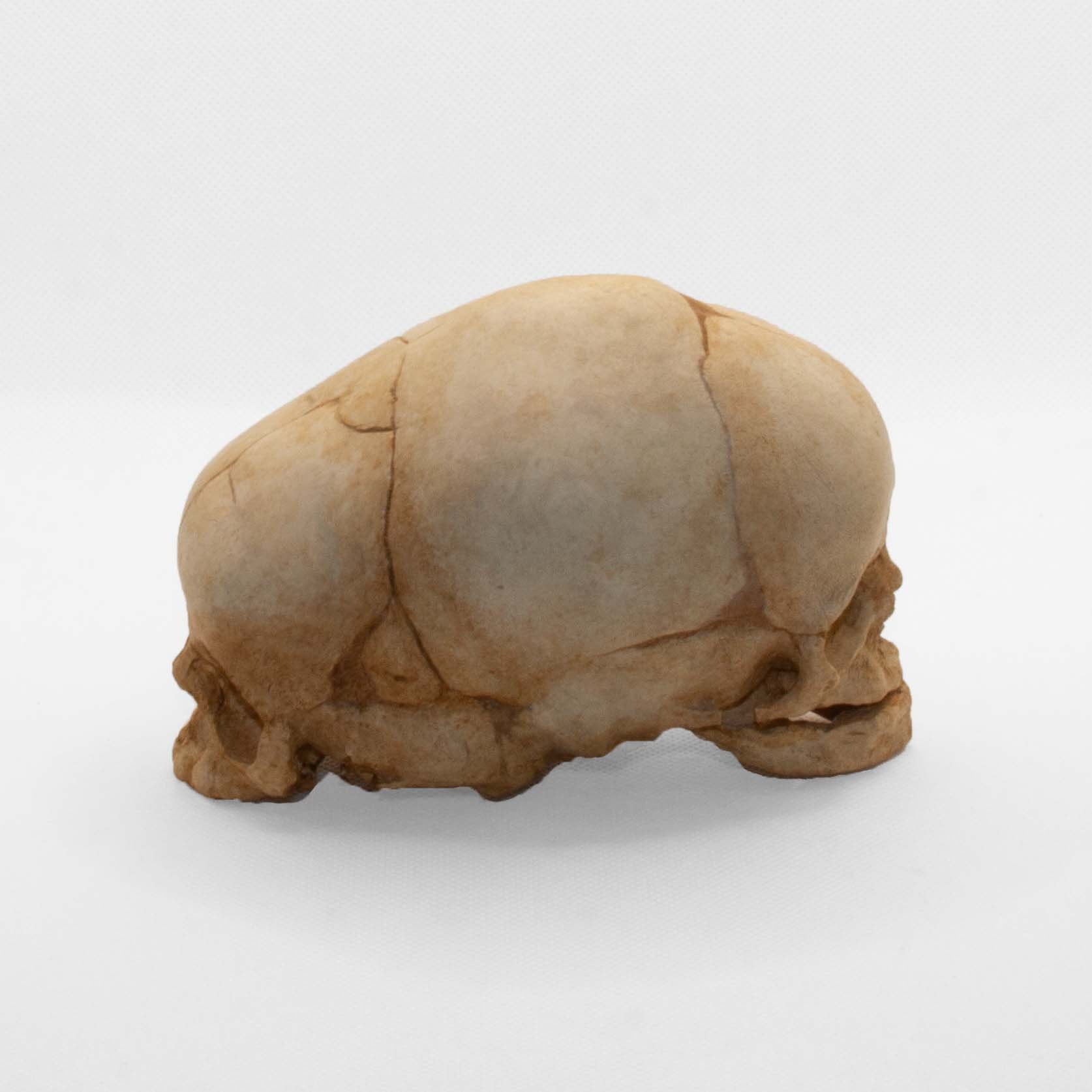 Timmy Diprosopia Skull – Anatomical Fetal Craniofacial Duplication