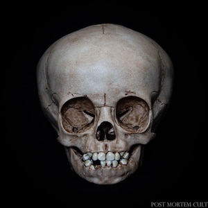 May include: A close-up of a human skull with teeth, showing the details of the bone structure. The skull is light brown in color and appears to be a real bone.