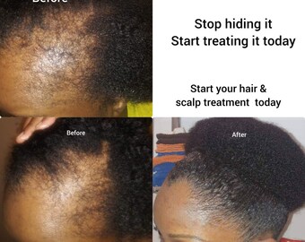 CHEBE  Intense Repair Serum, Hair Growth, Hair Moisturizer, Hair Growth, Hair Loss, Hair Loss Remedy, Hair Restoration, Alopecia, Baldness