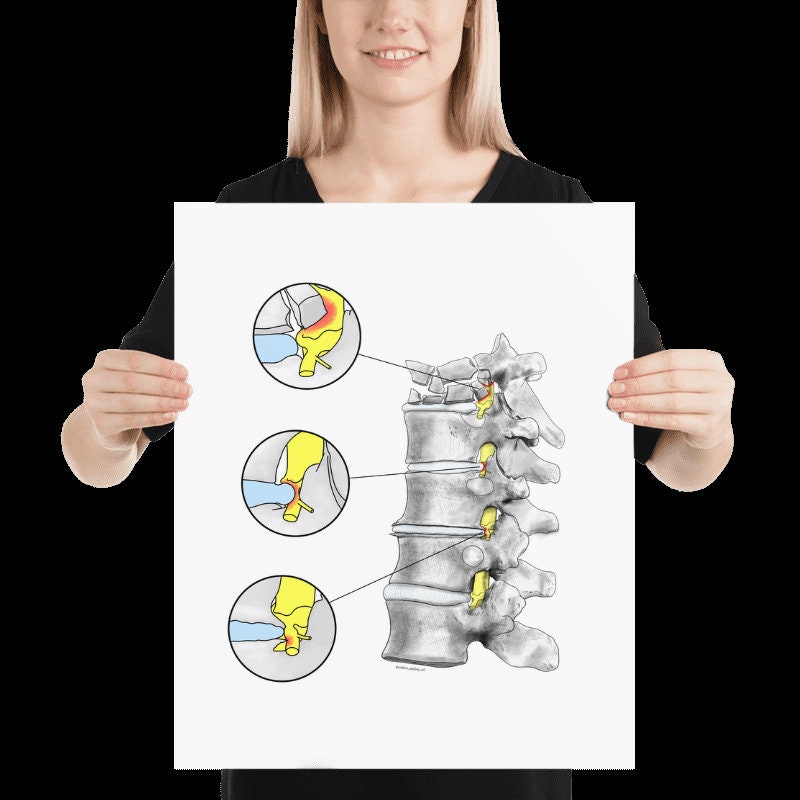 Vertebral Pathologies Vertebral Pathologies - Anatomy - Art - Without Frame - Etsy