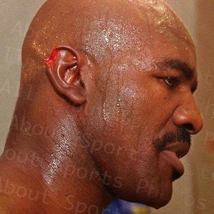 Evander Holyfield&#39;s Ear - After Mike Tyson took a bite