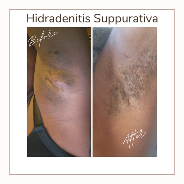 Hidradenitis Suppurativa ChoCho cream