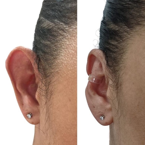 Corrector de oreja - Discreto