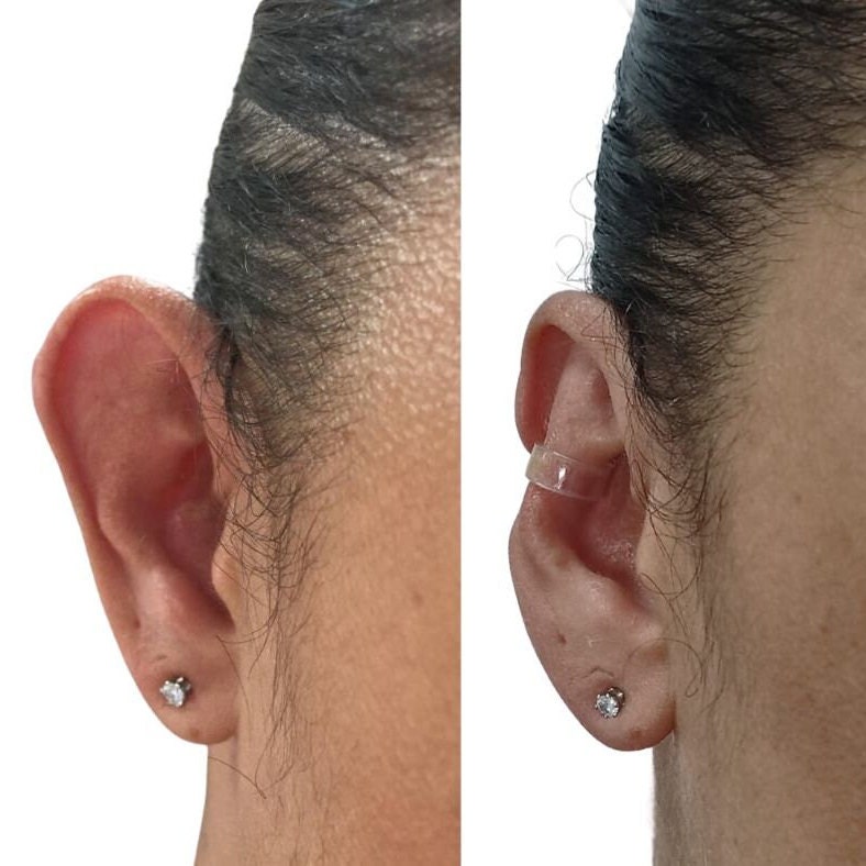OTOSTICK Autocollants de OTOSTICK oreille / Autocollants oreille collants -  Aide à