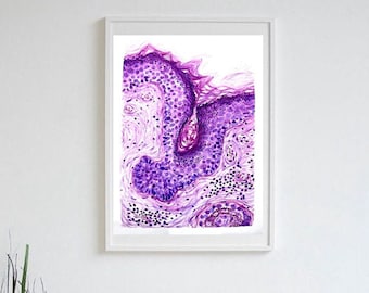 Carcinoma de células basales, histología de la piel, impresión de arte patológico