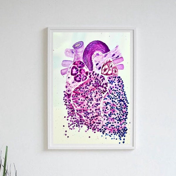 Cardiac Heart Pathology, Art Print, Gift for Doctor