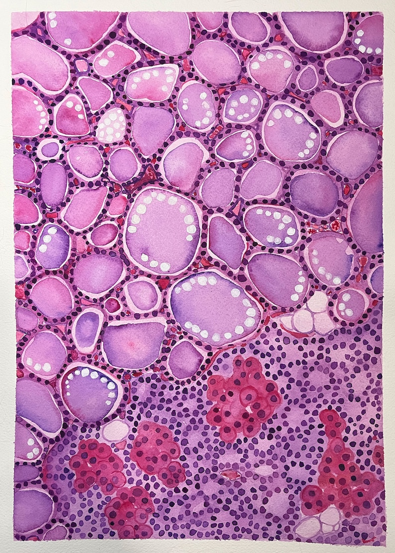 K&ouml;nnte beinhalten: Aquarellmalerei einer mikroskopischen Ansicht von Gewebezellen. Das Kunstwerk zeigt eine Vielzahl von Formen und Gr&ouml;&szlig;en in Rosa- und Lilat&ouml;nen, mit wei&szlig;en Punkten und dunkleren rosa Clustern. Der Gesamteffekt ist eine detaillierte und farbenfrohe Darstellung.