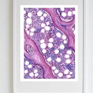Bone Marrow Hematopathology Print, High-Quality, Pathology Art