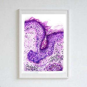 Basal cell carcinoma, skin histology, pathology art print
