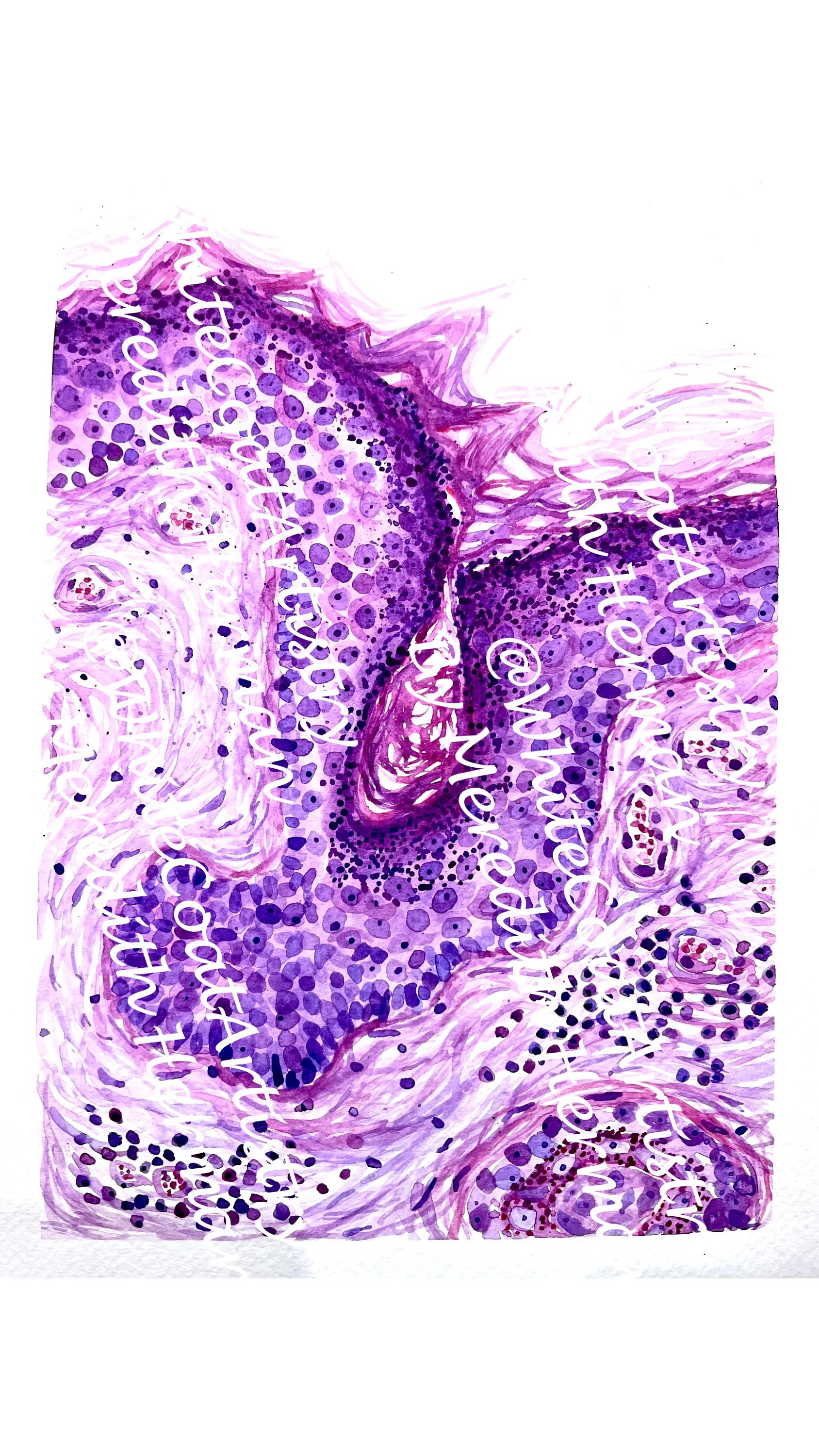 basal-cell-carcinoma-skin-histology-pathology-art-print-etsy-australia