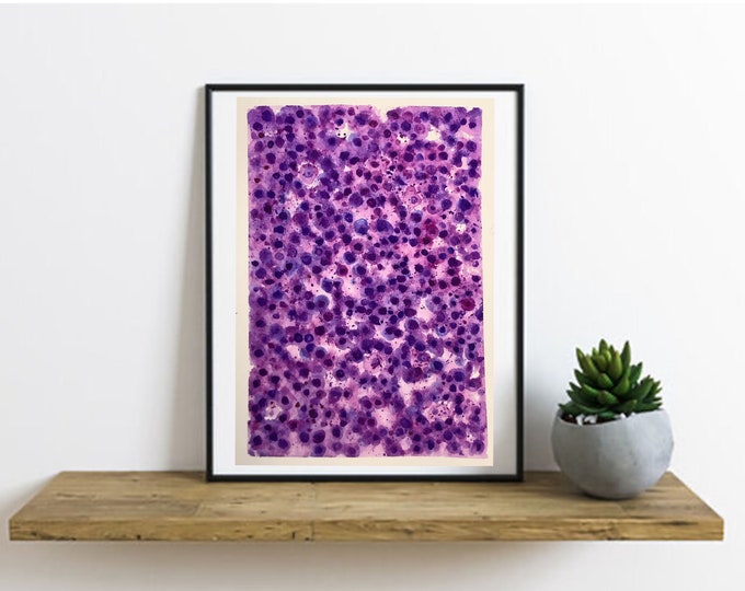 Original Burkitt Lymphoma Painting, Hemepath, Pathology Painting