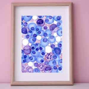 Multiple Myeloma II Art Print, Pathology Art Print