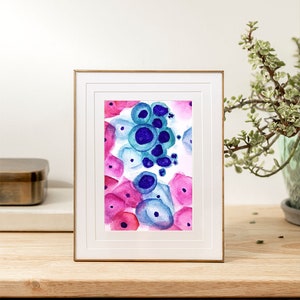 High-grade intraepithelial lesion (HSIL) on PAP smear painting print, pathology art, medical art, cytology