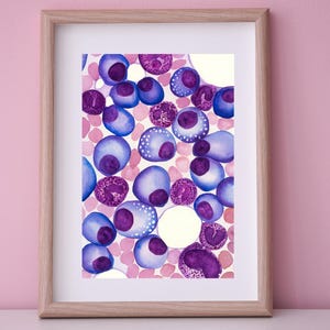 Multiple Myelom Pathologie Kunstdruck, Hämatopathologie, Blutkörperchen