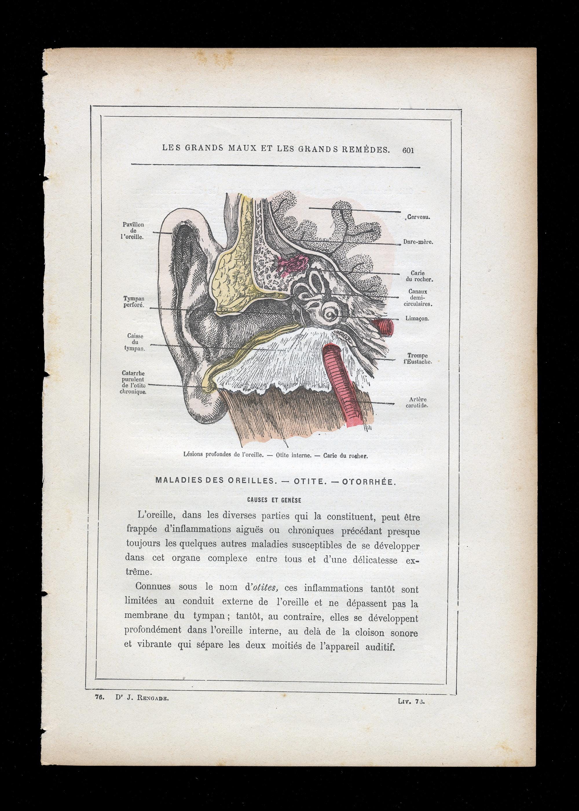 Antique French Ear Anatomy Print (1889) by Dr. J. Rengade | Otitis ...