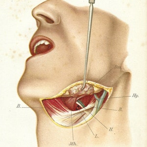 Puede incluir: Una ilustración anatómica detallada del cuello humano, que muestra los músculos, los nervios y los vasos sanguíneos. La imagen está etiquetada con términos anatómicos, incluyendo "B." para "Bauch", "Hy." para "Hyoid", "Sm." para "Submaxillary", "Mh." para "Mylohyoid", "L." para "Lingual" y "H." para "Hypoglossal".