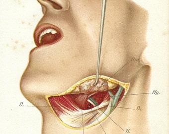 Lingual artery exposure | 1909 Colored Antique Medical Lithograph - Detailed Illustrations of Exposure of the lingual artery | Anatomy Print