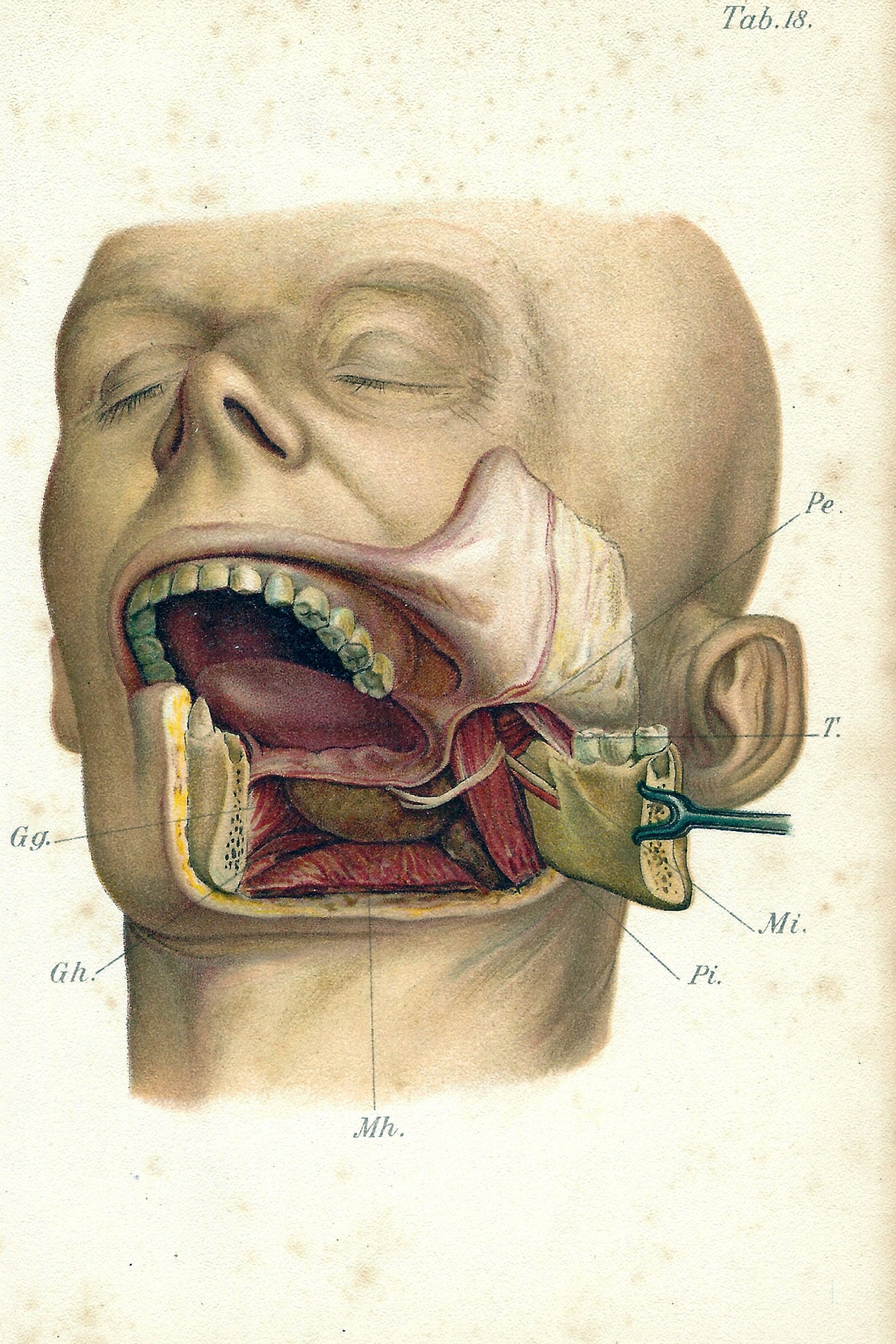 Jaw resection | 1909 Colored Antique Medical Lithograph - Detailed Illustrations of Resection of the mandible | Old Medical Print of Jaw