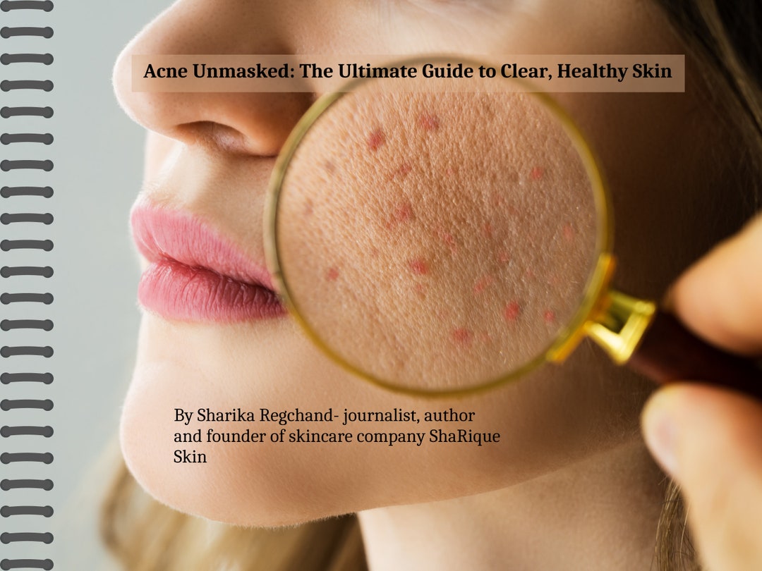 Acne Unmasked: the Ultimate Guide to Clear, Healthy Skin How to Get Rid 