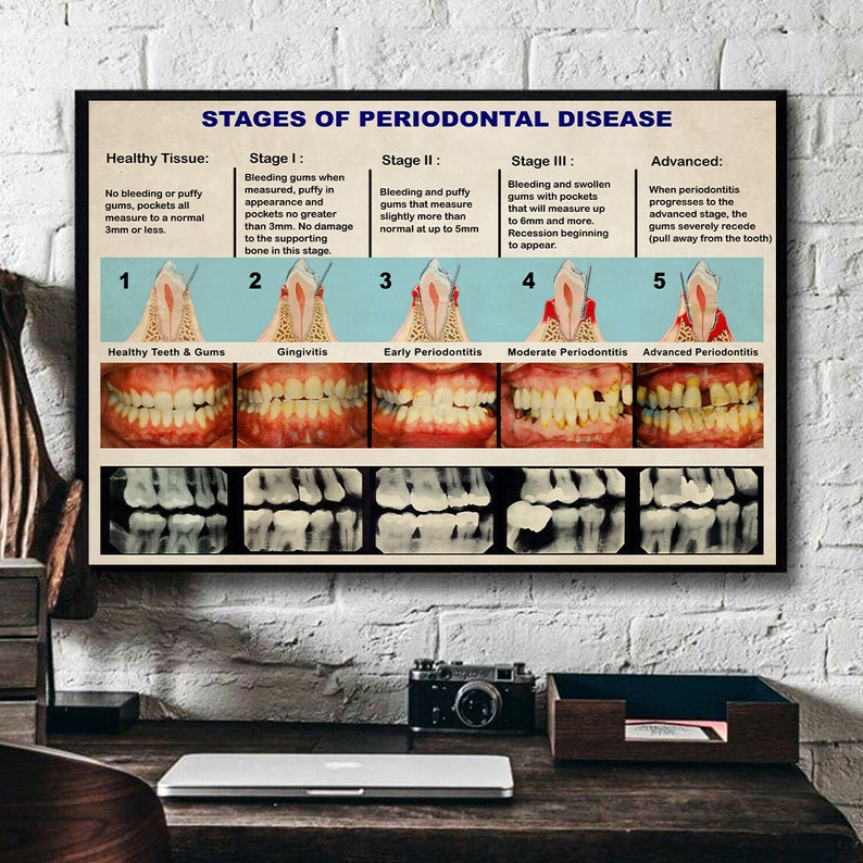 Dental Knowledge Poster Vintage Stages of Periodontal Disease Poster
