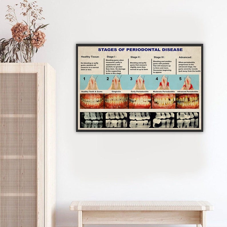 Dental Knowledge Poster Vintage Stages of Periodontal Disease Poster