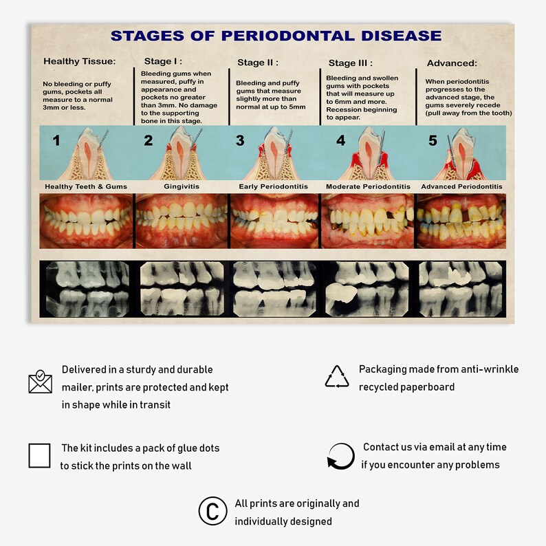 Dental Knowledge Poster Vintage Stages of Periodontal Disease Poster