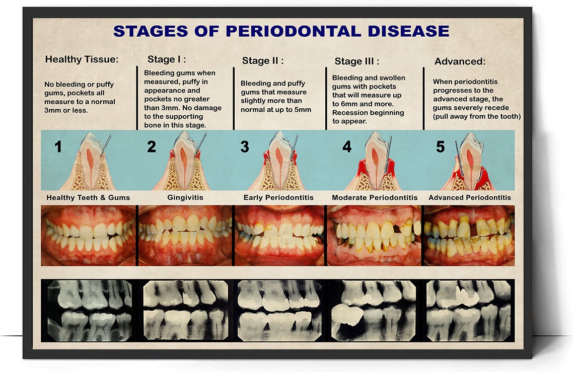 Dental Knowledge Poster Vintage Stages of Periodontal Disease Poster