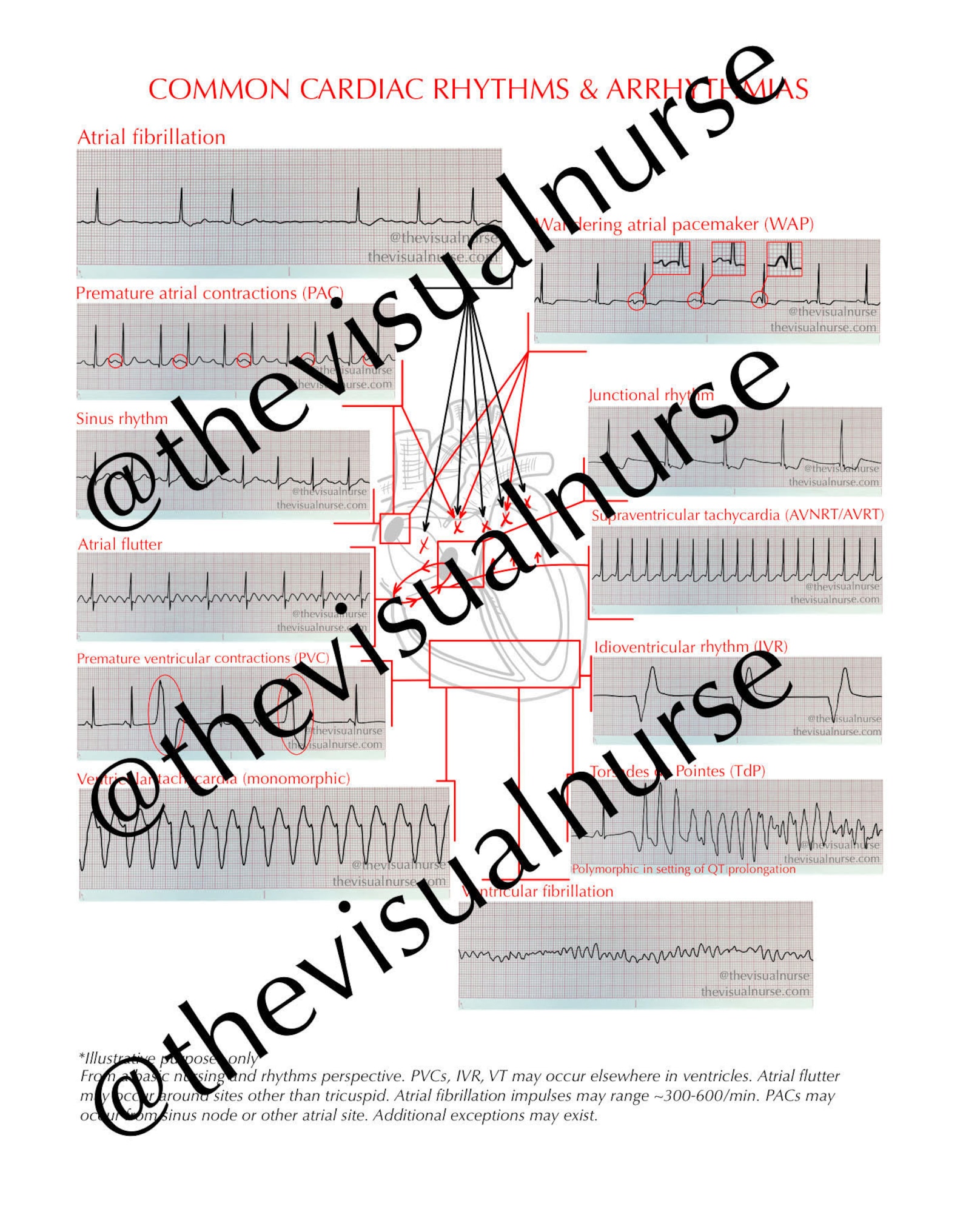 Common Cardiac Rhythms and Arrhythmias - PDF Instant Download - Etsy