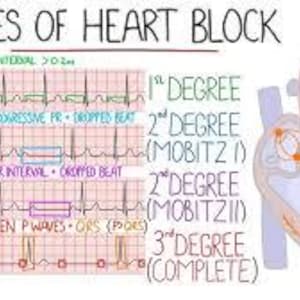 Può includere: Diagramma che illustra i diversi tipi di blocco cardiaco, tra cui il blocco di primo grado, il blocco di secondo grado (Mobitz I e Mobitz II) e il blocco di terzo grado (completo). Il diagramma mostra l'intervallo PR, il PR progressivo, l'intervallo PR fisso e nessuna relazione tra le onde P e le QRS (scarso).