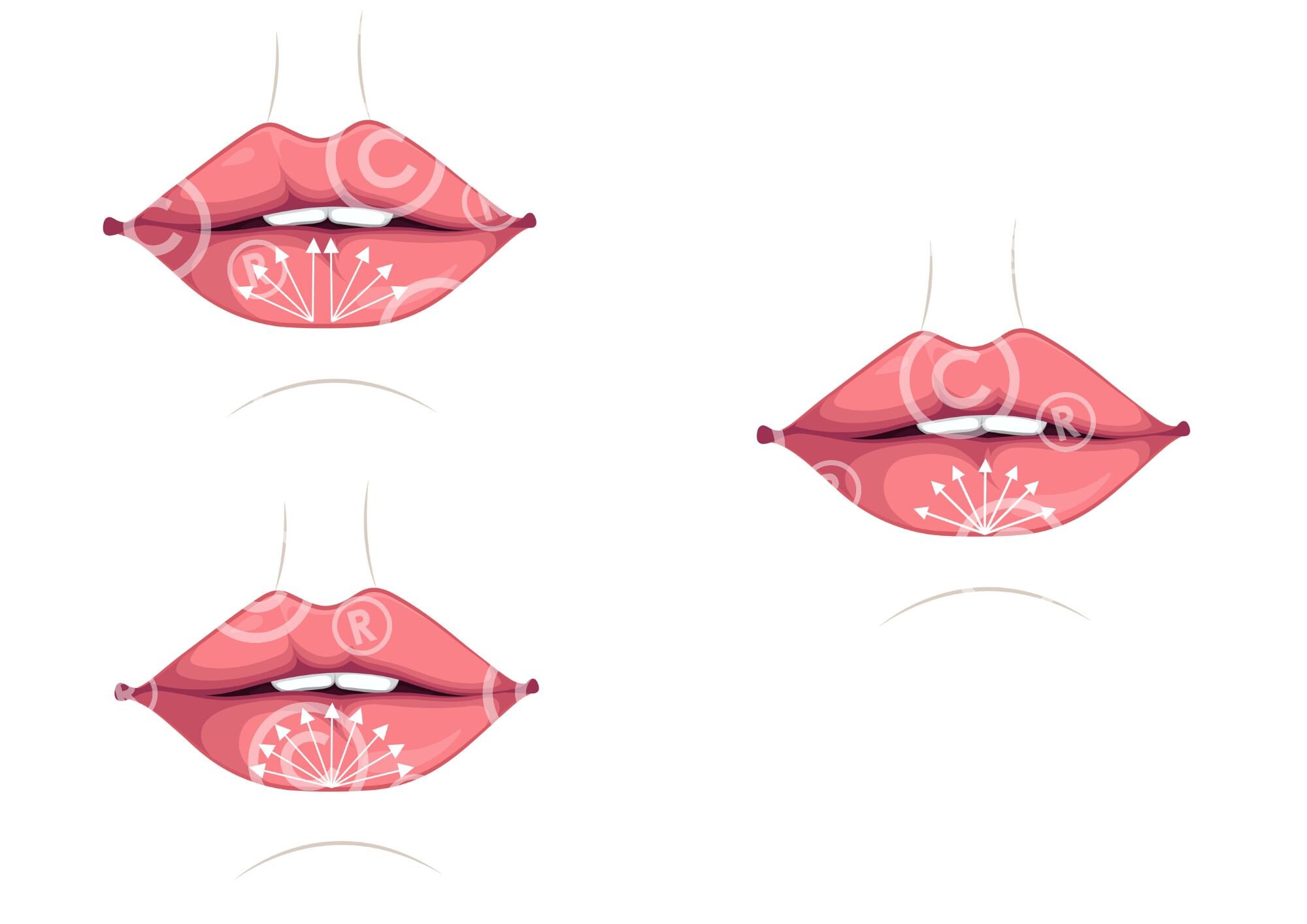 Russian Lip Filler Injection Techniques | Dermal Filler | Illustrations ...