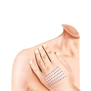 Mesotherapy Injection Patterns | Botox & Filler Injector | Anatomy ...