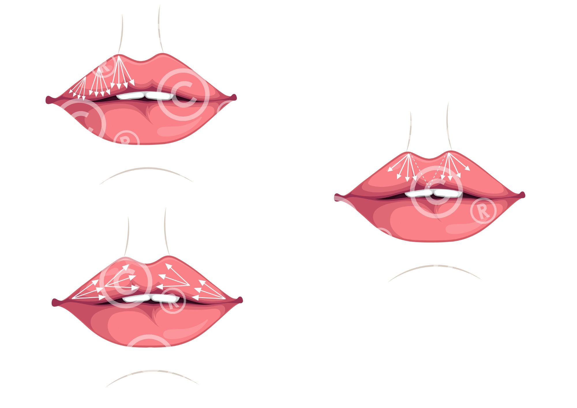 Russian Lip Filler Injection Techniques | Dermal Filler | Illustrations ...