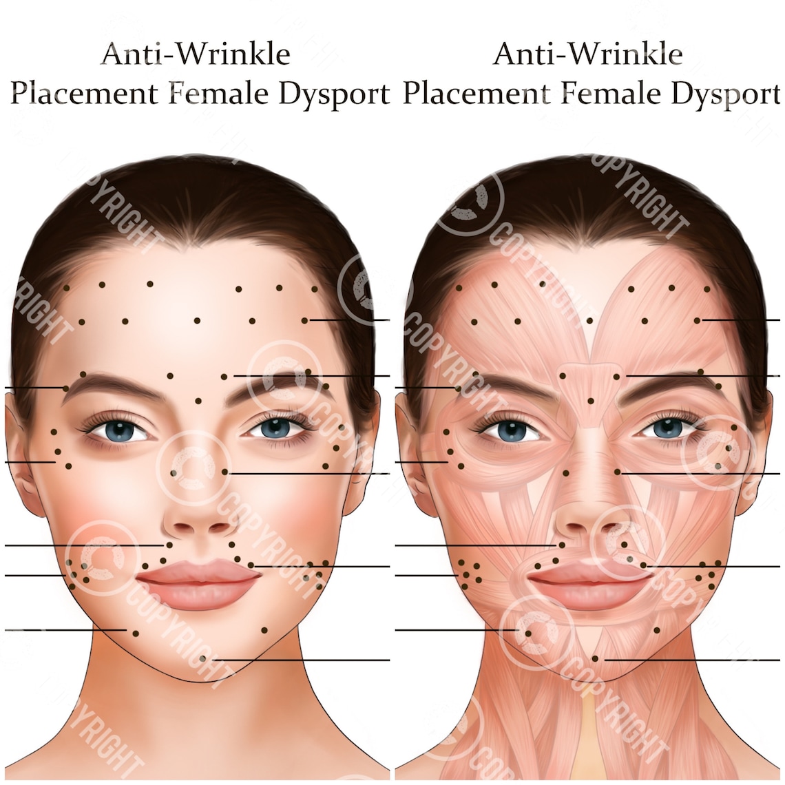 Dysport Injection Points Bundle | Botox Filler Injector | Anatomy ...