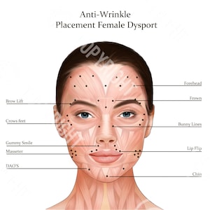 Könnte beinhalten: Diagramm, das die Platzierung von Dysport-Injektionen zur Behandlung von Falten im Gesicht einer Frau zeigt. Das Diagramm zeigt die Stirn, die Zornesfalten, die Nasenfalten, den Lip Flip und das Kinn.