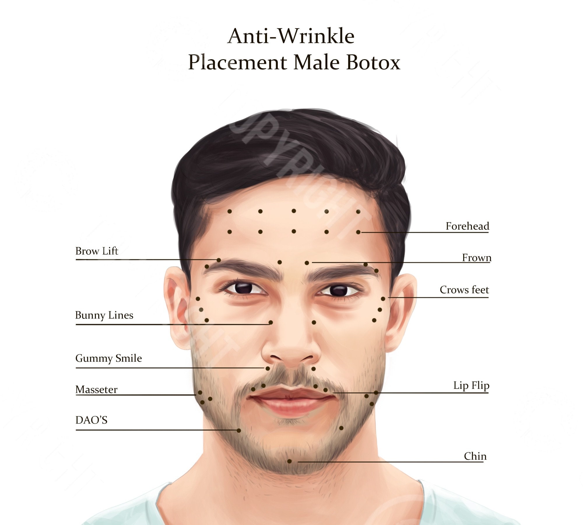 Male botox injection points bundle botox filler injector anatomy