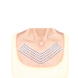 Mesotherapy Injection Patterns | Botox & Filler Injector | Anatomy ...