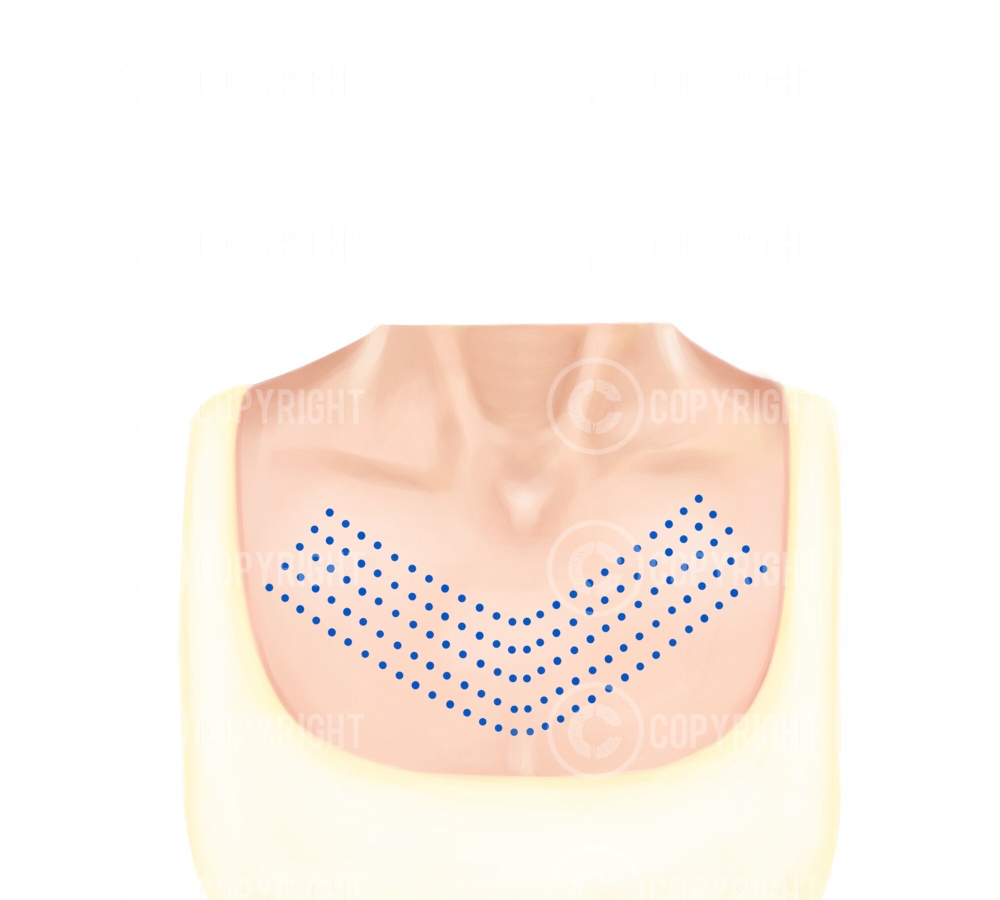 Botox Injecton Pattern For Men Mesotherapy Injection Patterns | Botox & Filler Injector | Anatomy ...