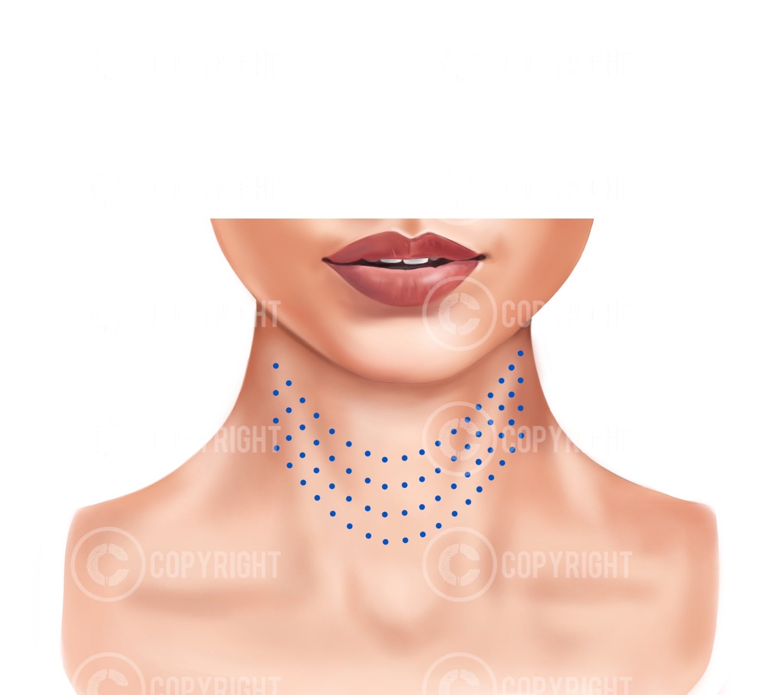 Mesotherapy Injection Patterns | Botox & Filler Injector | Anatomy ...